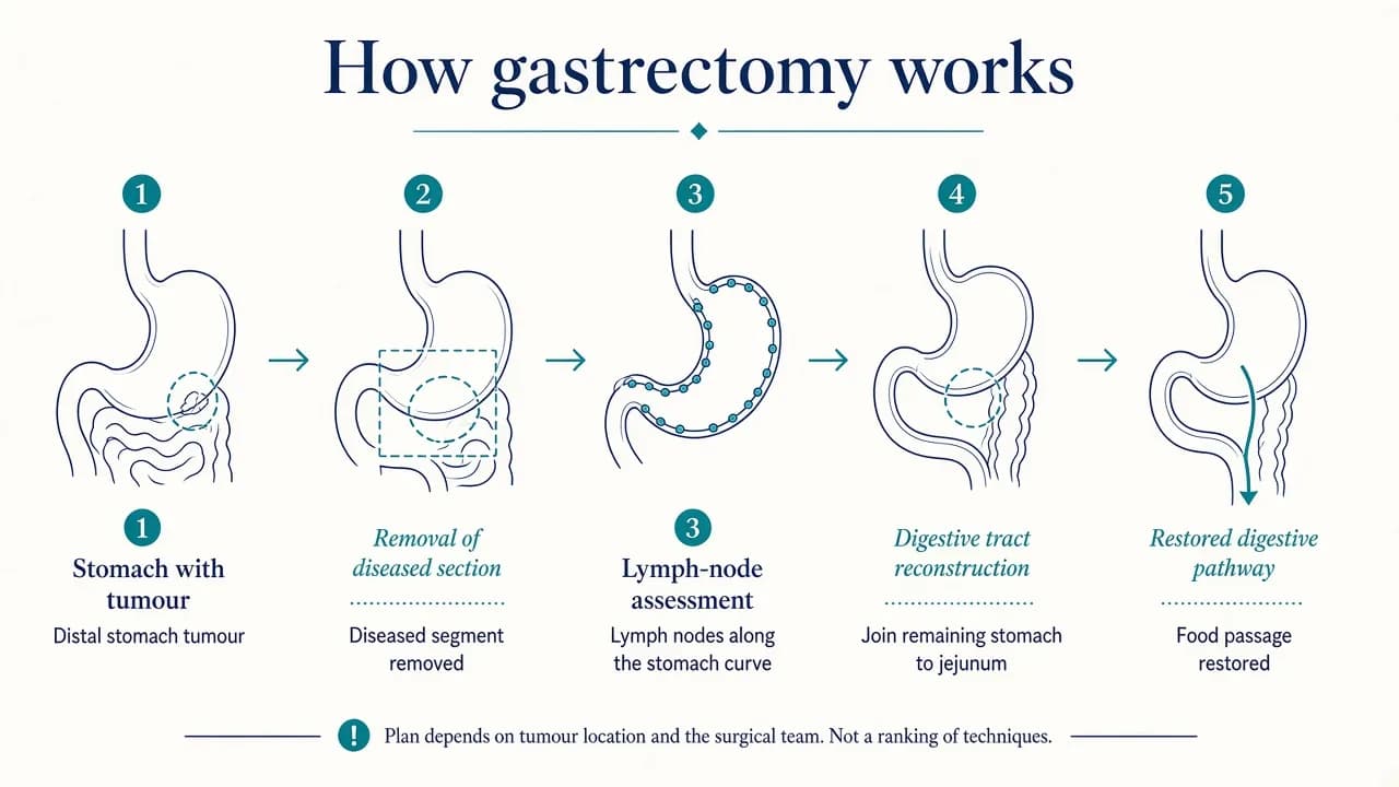 Medical illustration showing the main steps of gastrectomy from removal of diseased stomach tissue to digestive tract reconstruction