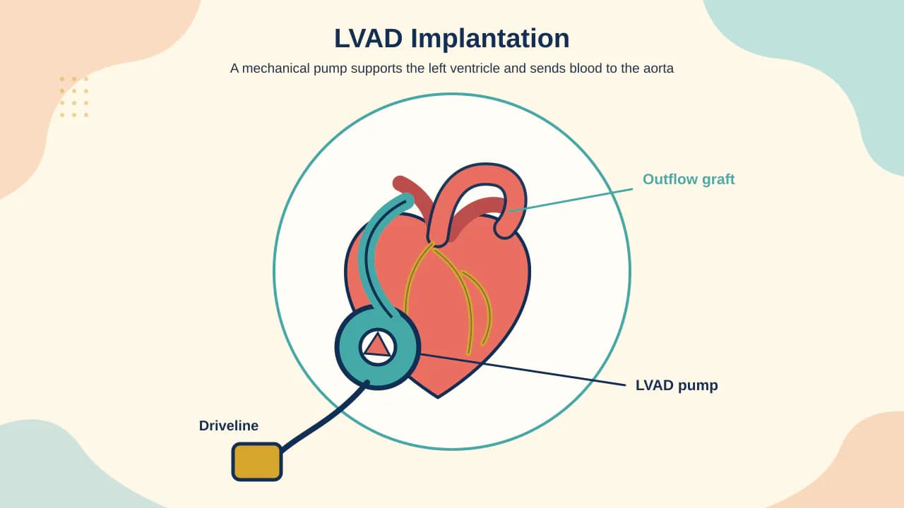 Medical illustration of a durable LVAD pump, ventricular inflow, aortic outflow graft, driveline, controller and external batteries