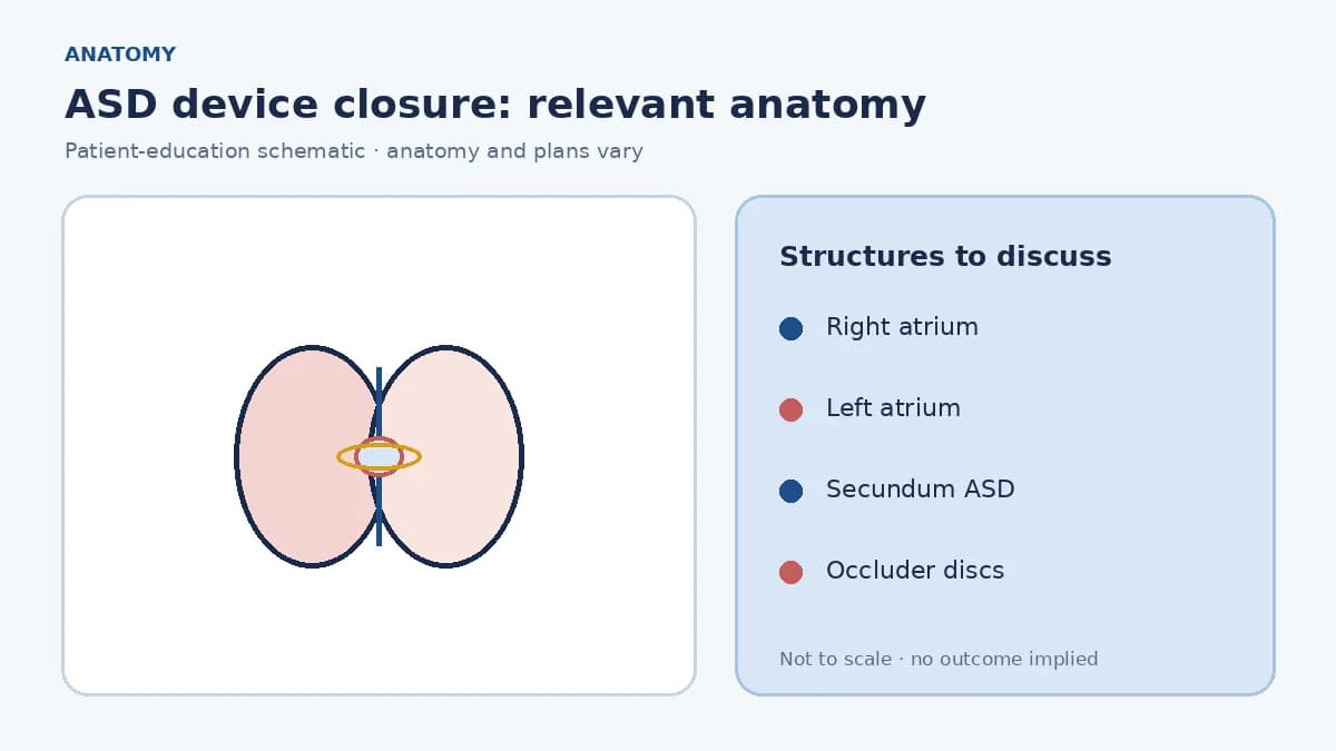 Medical illustration of a secundum atrial septal defect allowing blood to pass between the atria