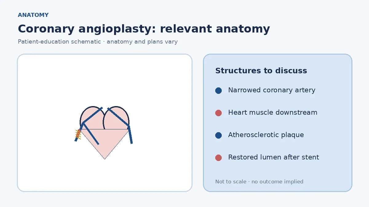 Medical illustration of a coronary artery with atherosclerotic narrowing reducing blood flow to heart muscle