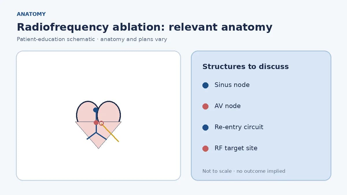 Medical illustration of cardiac conduction pathways and an example re-entry circuit targeted by radiofrequency ablation