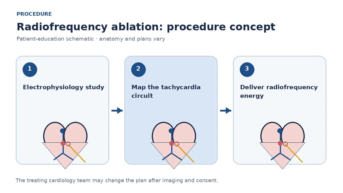 Clinical diagram of diagnostic and ablation catheters mapping a tachycardia circuit and delivering radiofrequency energy