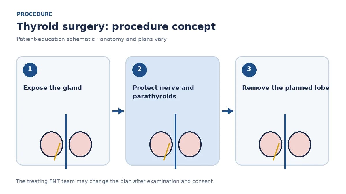 Clinical diagram of planned thyroid-lobe removal while protecting the recurrent laryngeal nerve