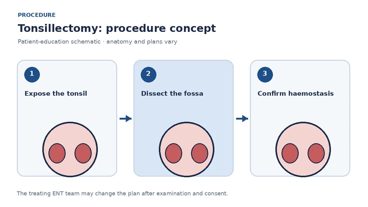 Clinical diagram of tonsil dissection from the tonsillar fossa during tonsillectomy