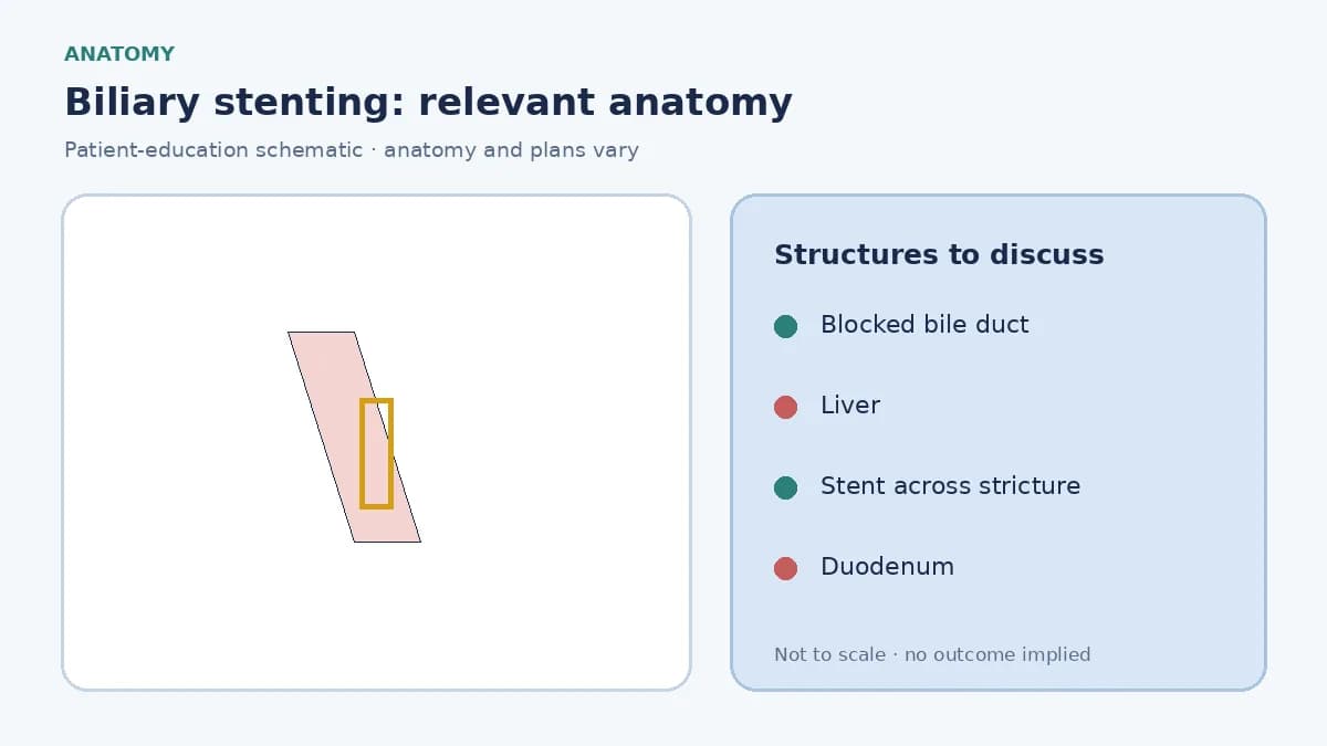 Medical illustration of a narrowed bile duct causing backup of bile toward the liver