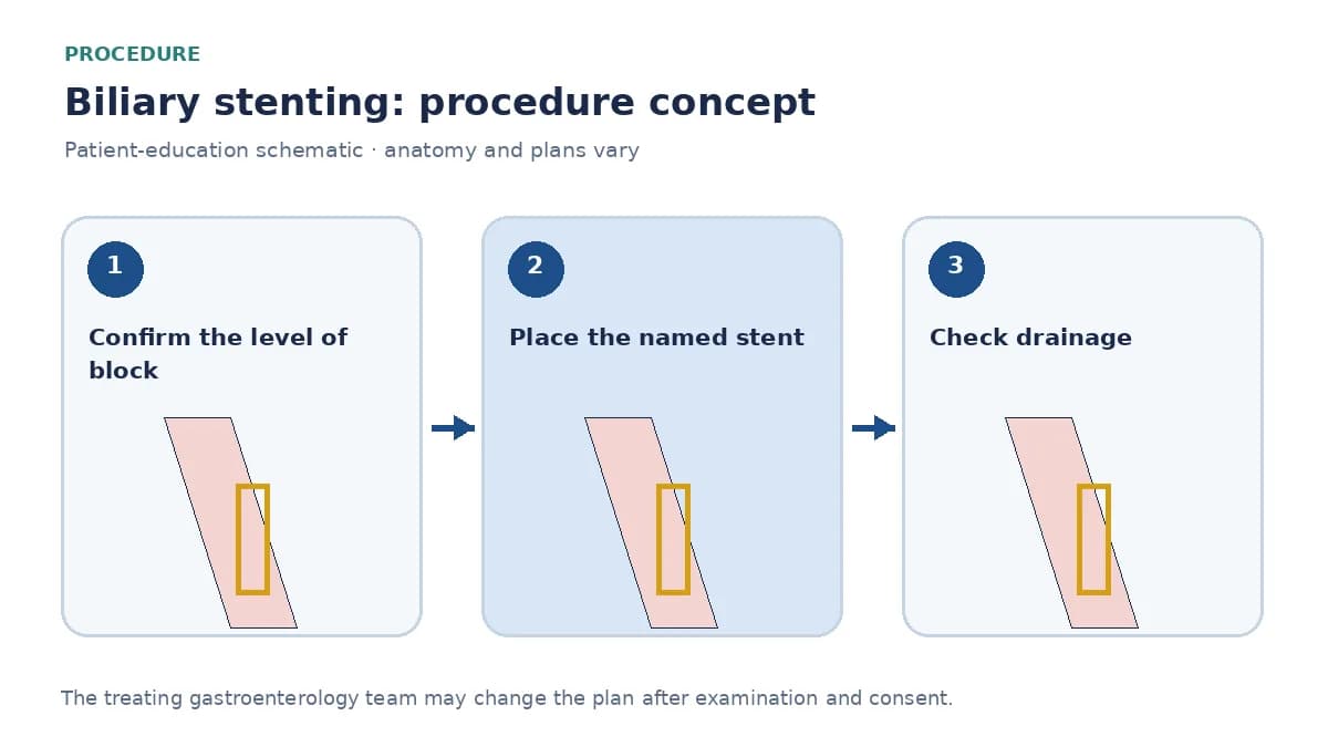 Clinical diagram of a plastic or metal stent crossing a biliary stricture