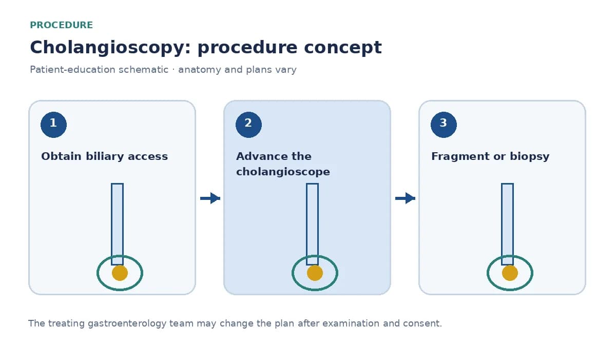 Clinical diagram of direct-vision lithotripsy of a difficult bile-duct stone