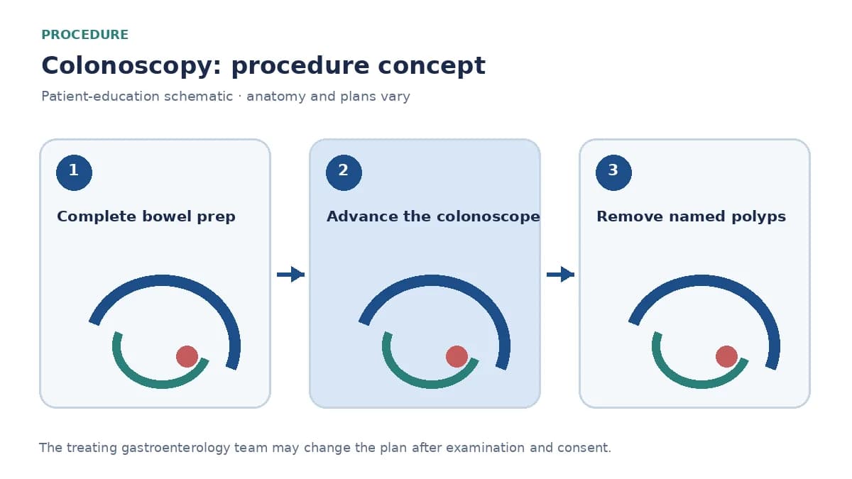 Clinical diagram of a colonoscope advancing through the large intestine toward a polyp