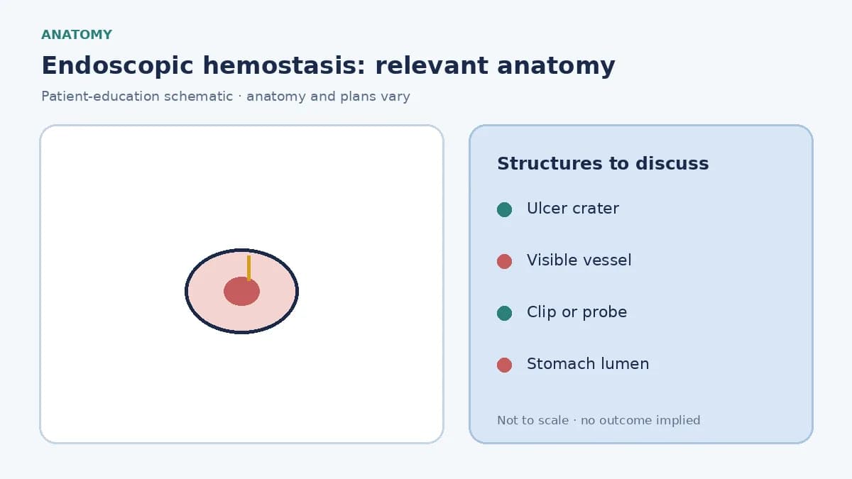 Medical illustration of an ulcer with a visible vessel in the stomach lining
