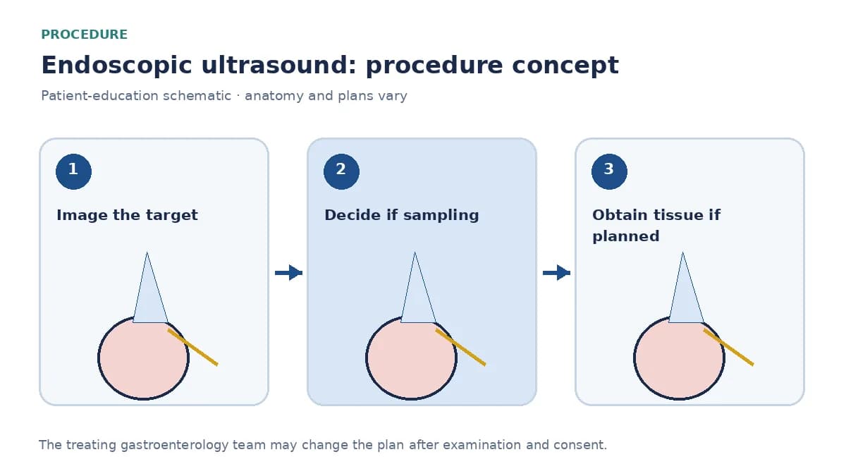 Clinical diagram of an echoendoscope and needle sampling a pancreatic lesion