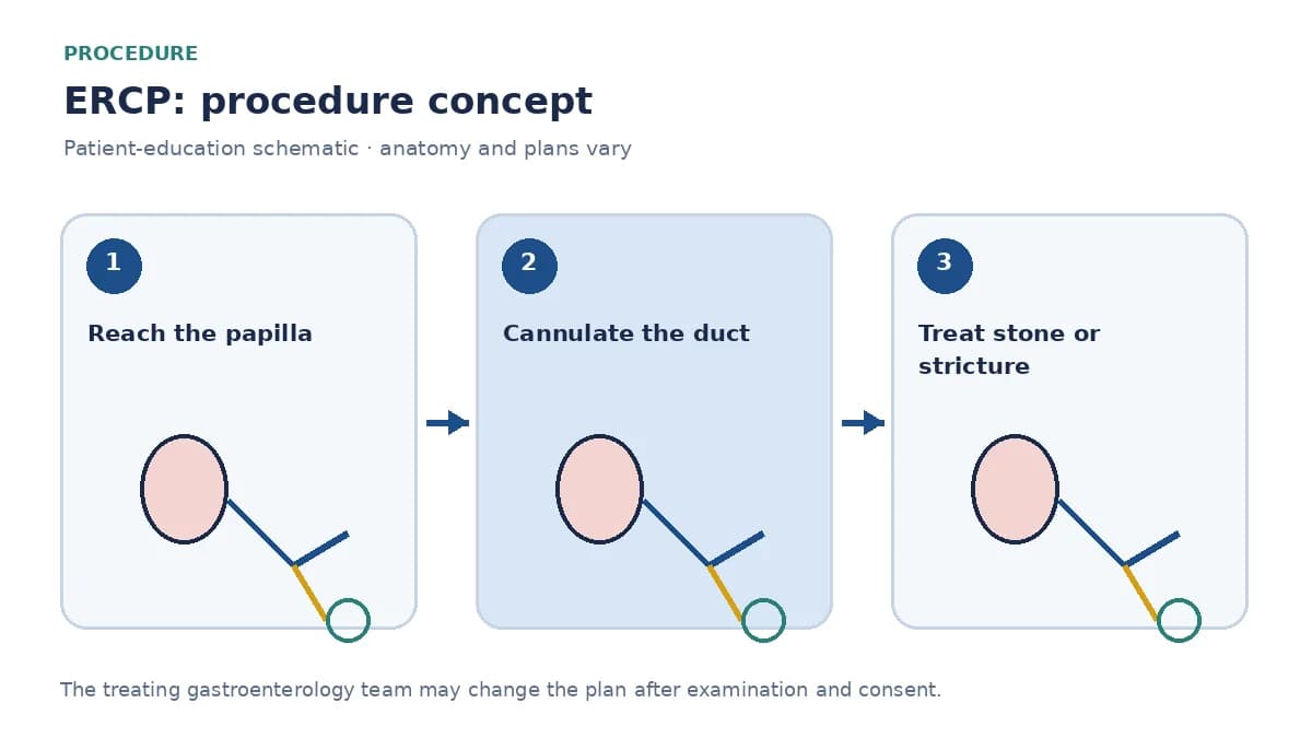 Clinical diagram of a side-viewing endoscope cannulating the bile duct during ERCP