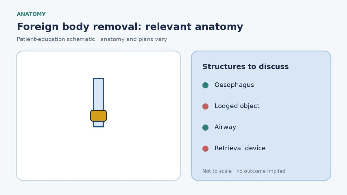 Medical illustration of a swallowed foreign object lodged in the oesophageal lumen