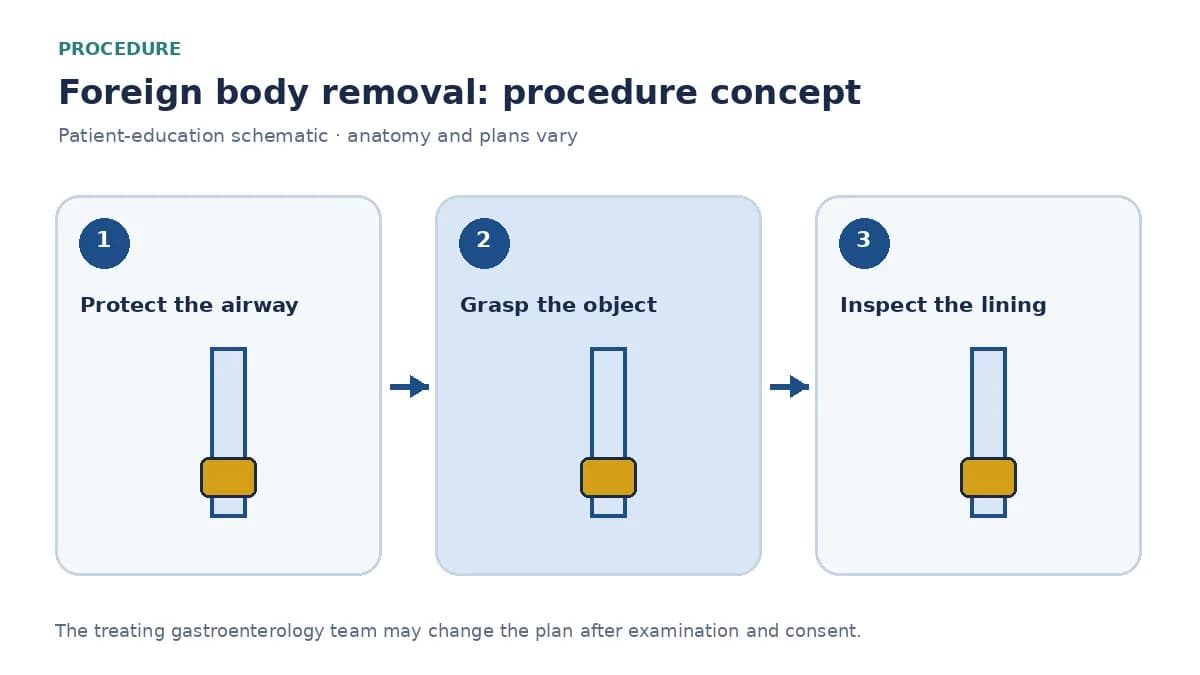 Clinical diagram of endoscopic graspers retrieving a foreign body through an overtube