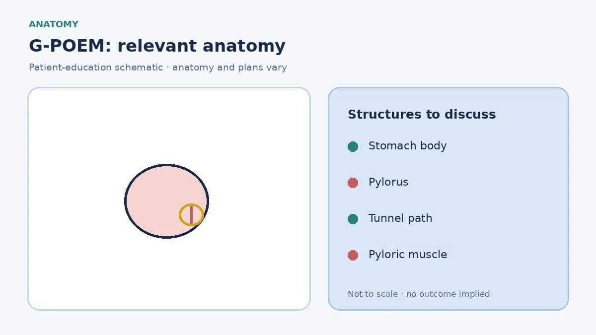 Medical illustration of the stomach and a narrowed pylorus delaying emptying