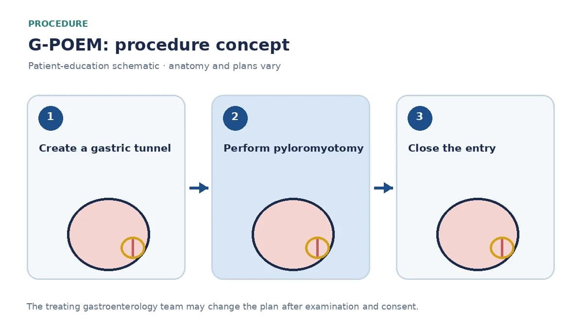 Clinical diagram of an endoscopic pyloric myotomy performed through a gastric tunnel during G-POEM