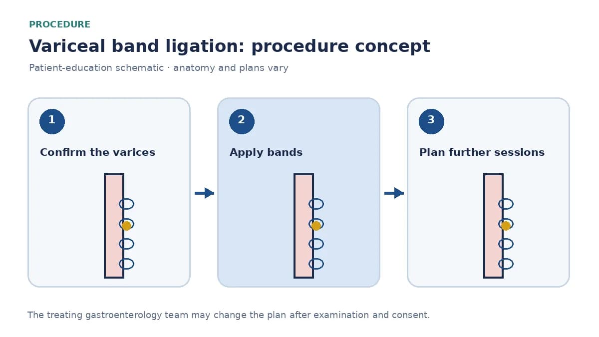 Clinical diagram of elastic bands placed on oesophageal variceal columns during ligation