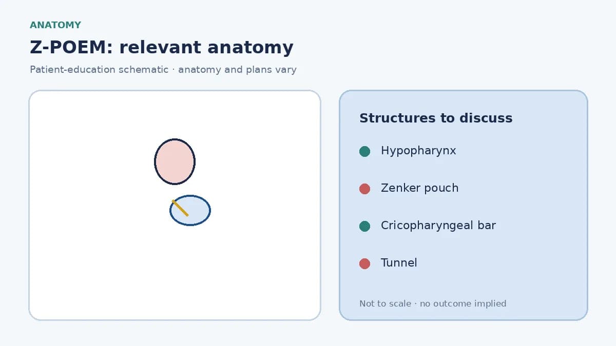 Medical illustration of a Zenker diverticulum pouch behind the cricopharyngeal bar