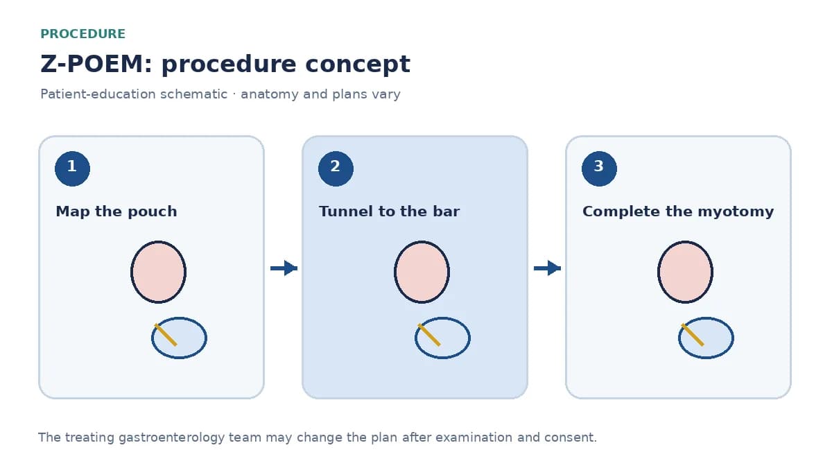 Clinical diagram of a submucosal tunnel approaching the Zenker septum during Z-POEM