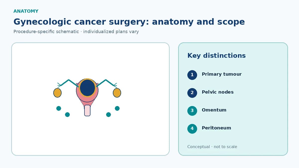 Patient-education gynecologic oncology schematic showing uterus cervix ovaries peritoneum omentum and pelvic lymph nodes as distinct staging sites