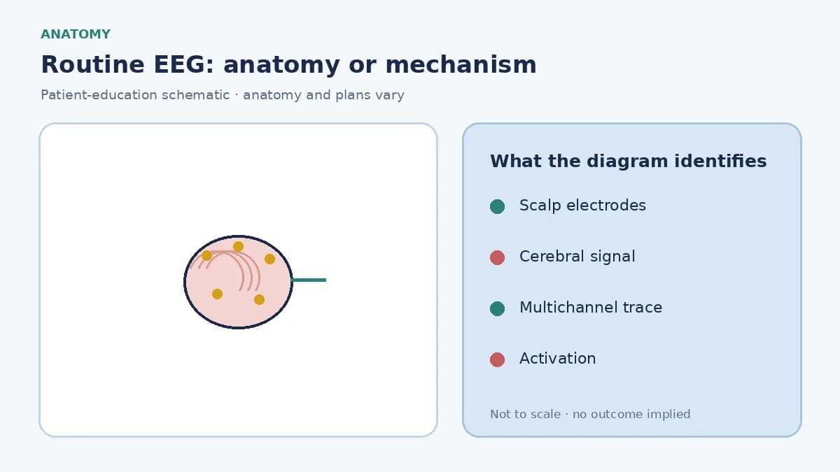 Patient-education diagram showing scalp EEG electrodes recording cerebral electrical signals into a multichannel trace