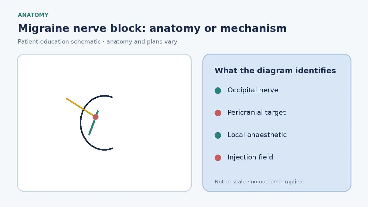 Patient-education diagram showing greater occipital and selected pericranial nerve targets for local migraine injections