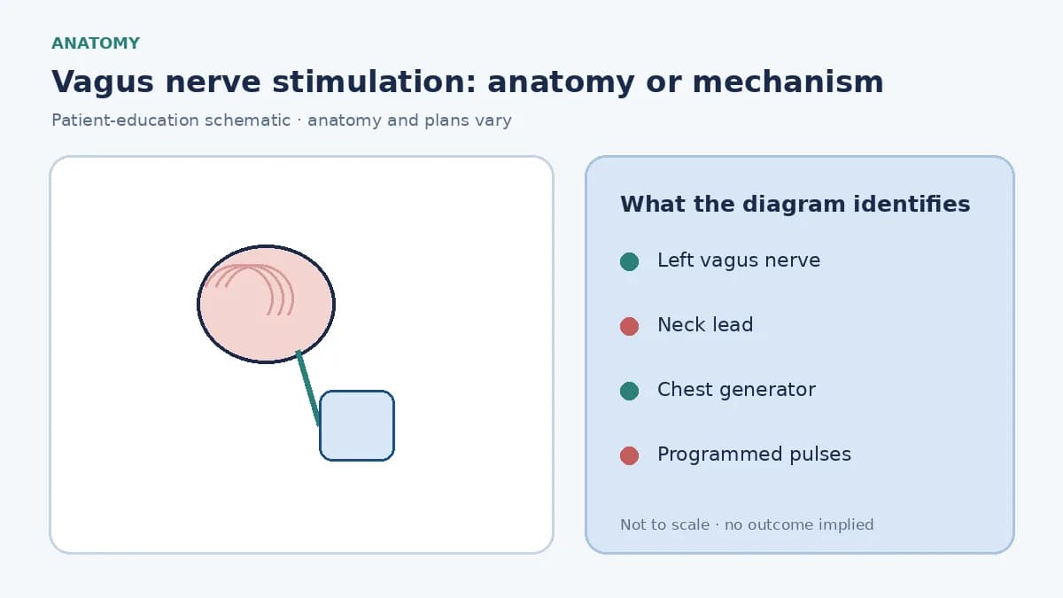 Patient-education diagram showing a chest pulse generator connected to a lead around the left cervical vagus nerve