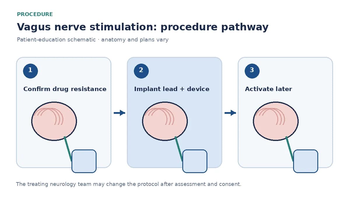 Numbered VNS pathway showing epilepsy review, lead and generator implantation, and later activation