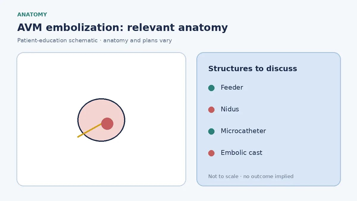 Medical illustration of an AVM nidus with a microcatheter in a feeding artery ready for embolization