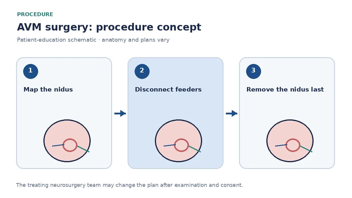 Clinical diagram of microsurgical AVM resection after craniotomy, taking feeders before the draining vein