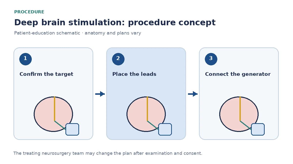 Clinical diagram of DBS lead placement and connection to a chest pulse generator