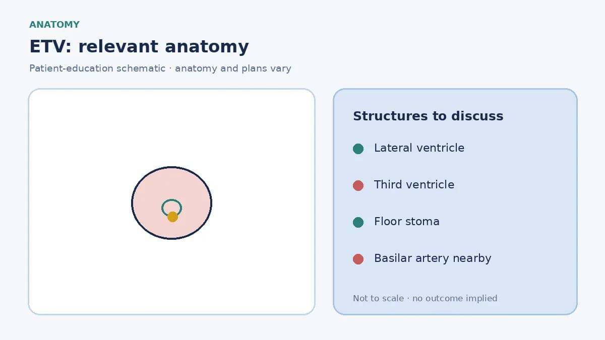 Medical illustration of obstructive hydrocephalus and the third-ventricle floor targeted in ETV