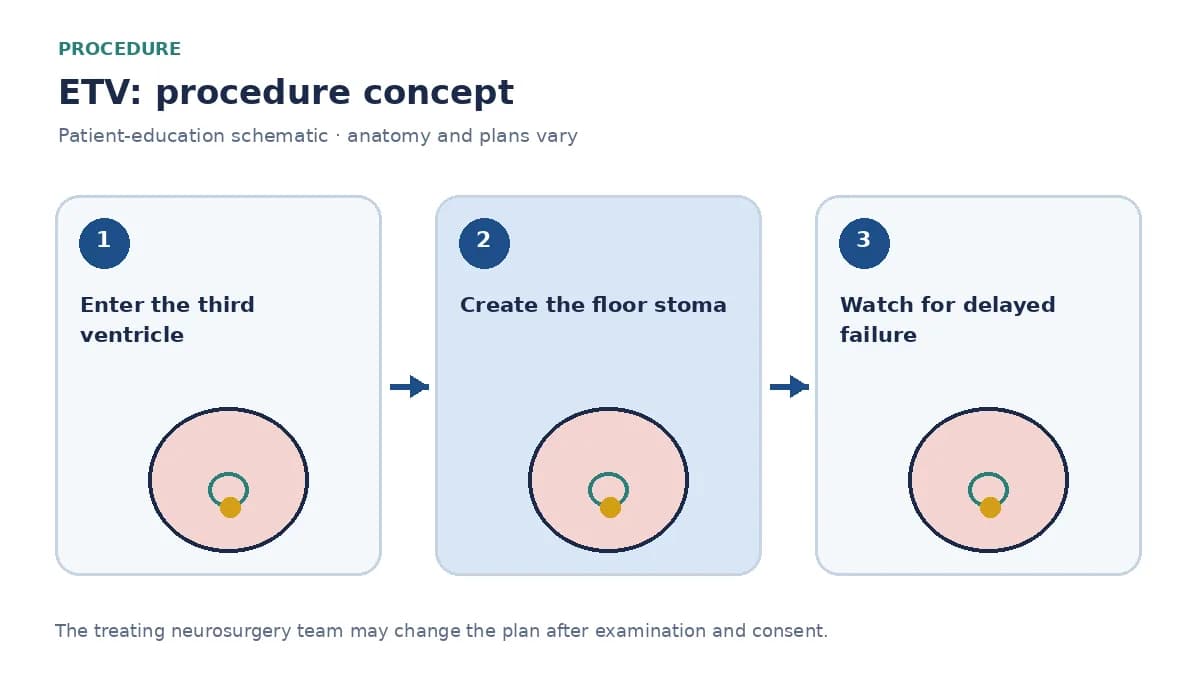 Clinical diagram of an endoscope creating a stoma in the third-ventricle floor to bypass aqueduct obstruction