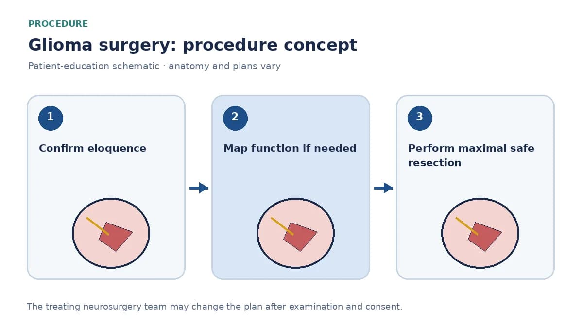 Clinical diagram of glioma resection using neuronavigation and optional awake mapping