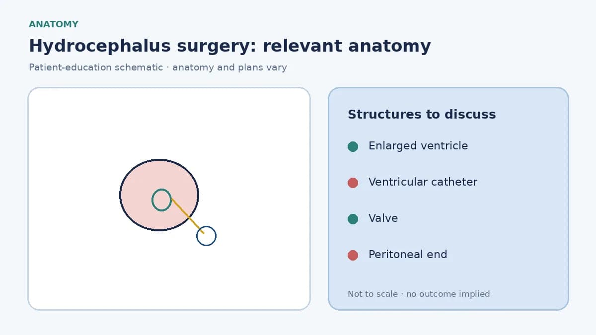 Medical illustration of enlarged cerebral ventricles in hydrocephalus and the planned ventricular catheter path