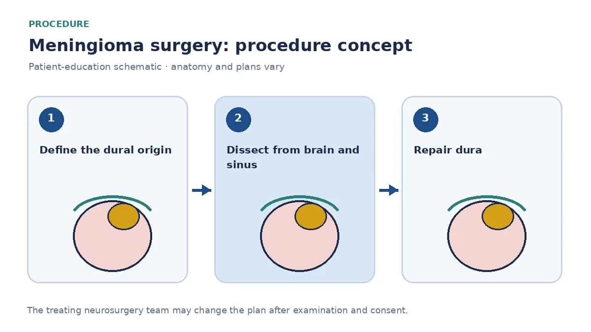 Clinical diagram of meningioma resection from brain, venous sinus and cranial nerves