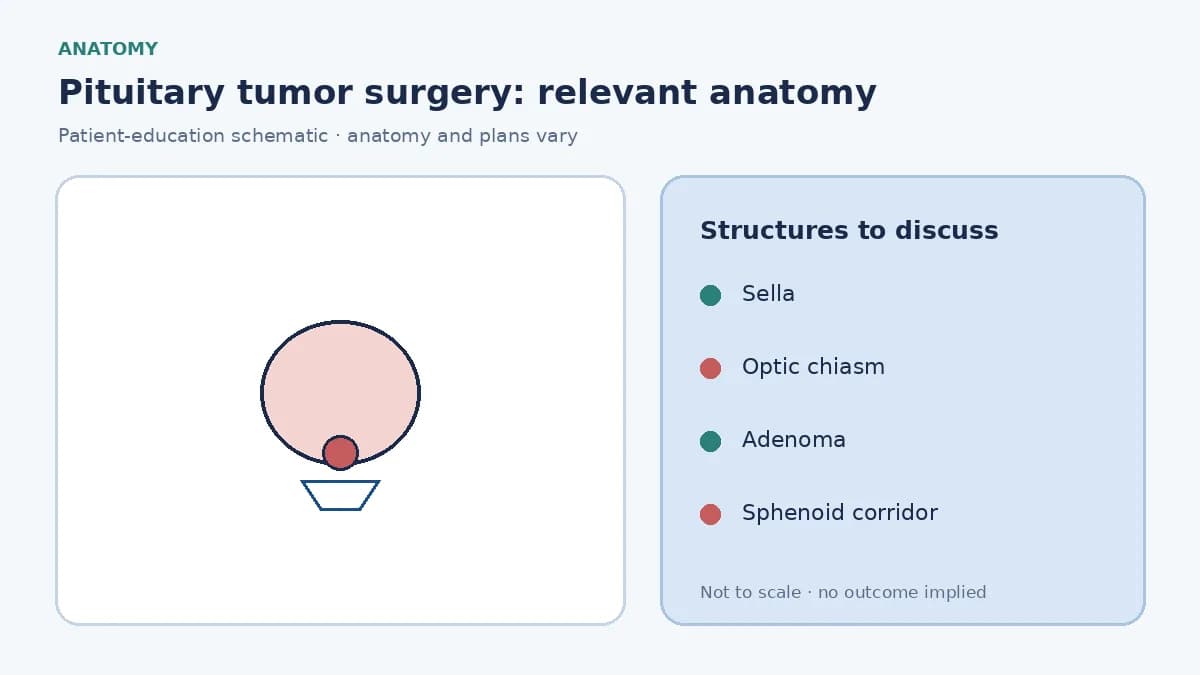 Medical illustration of a pituitary adenoma in the sella pressing on the optic chiasm