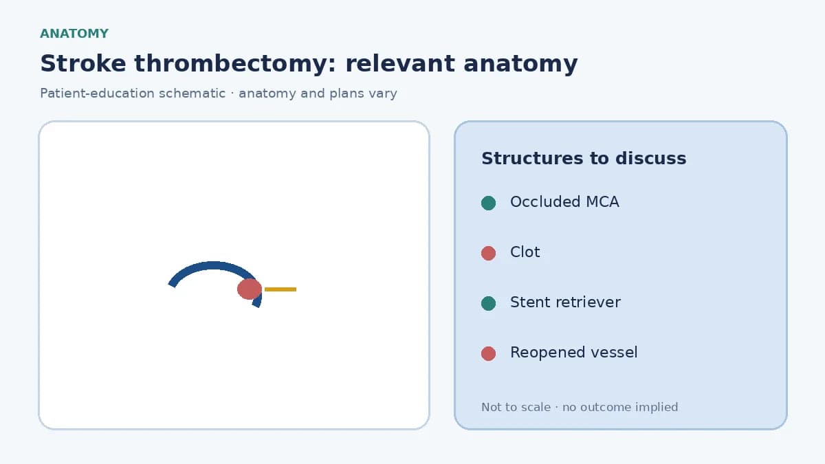 Medical illustration of a large-vessel occlusion in the middle cerebral artery causing acute ischaemic stroke