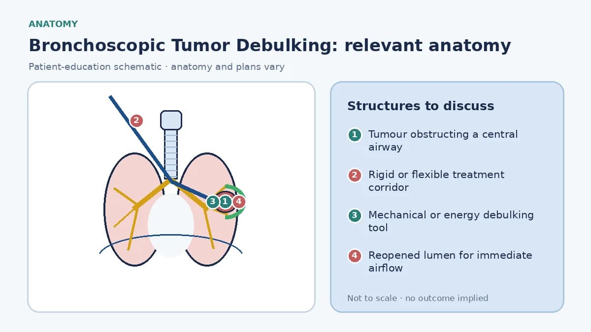 Educational central-airway schematic showing tumour narrowing a main bronchus, a rigid treatment corridor, mechanical or energy debulking tool, haemostasis zone and reopened lumen without implying cancer cure