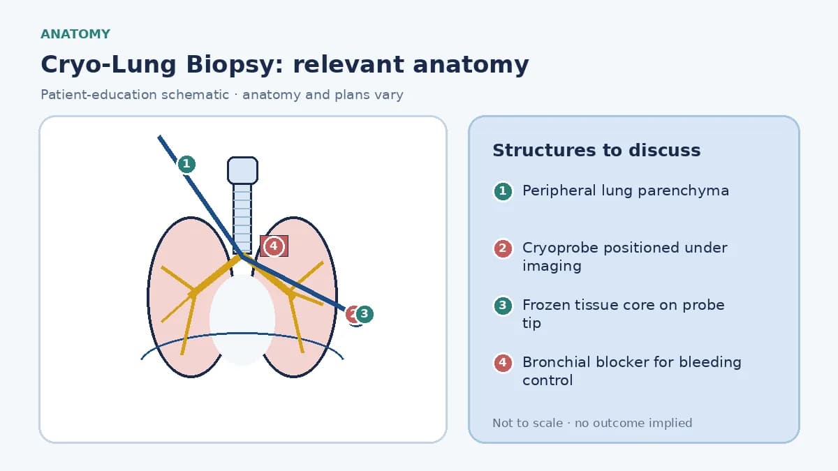 Educational lung schematic showing a cryoprobe positioned fluoroscopically in peripheral parenchyma, a frozen tissue core at its tip, measured pleural distance and a bronchial blocker isolating the sampled lobe