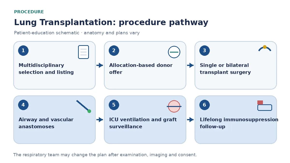 Lung-transplant pathway showing multidisciplinary selection and lawful listing, allocation-based donor offer, single or bilateral surgery, airway and vascular connections, ICU graft surveillance and rehabilitation