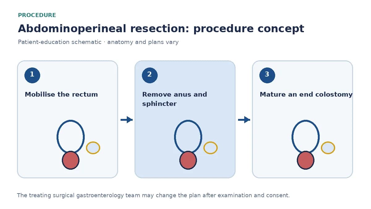 Clinical diagram of abdominoperineal resection with permanent end colostomy and perineal wound