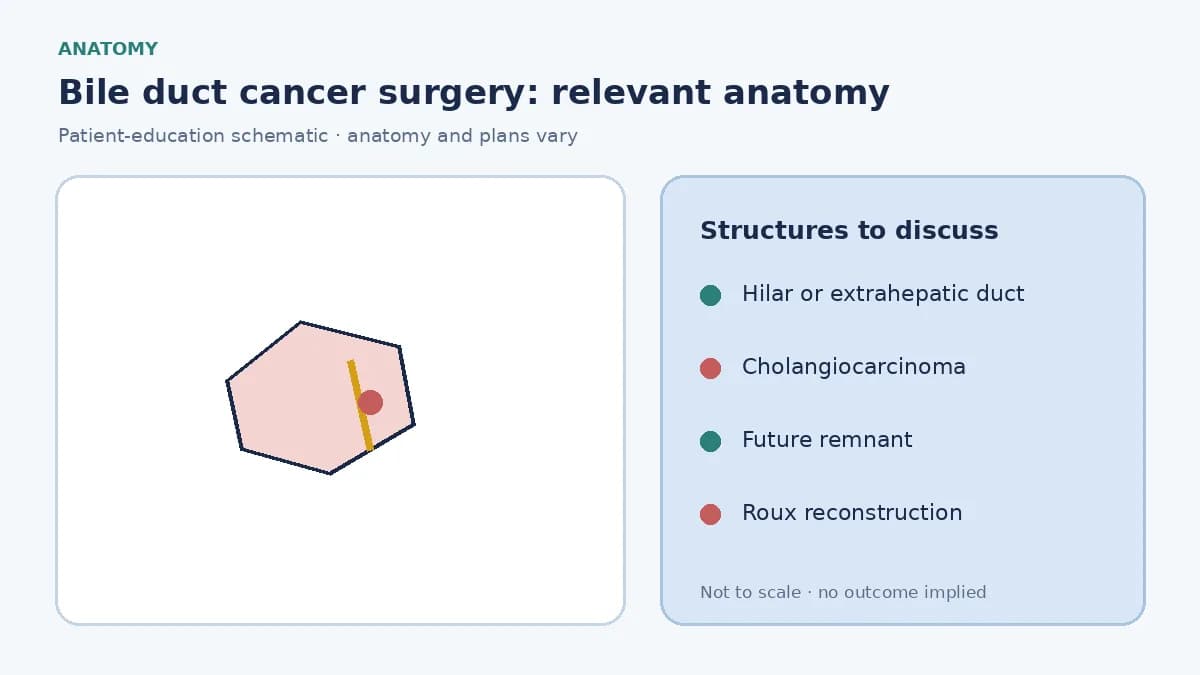 Medical illustration of extrahepatic and hilar bile ducts showing a cholangiocarcinoma and the future liver remnant