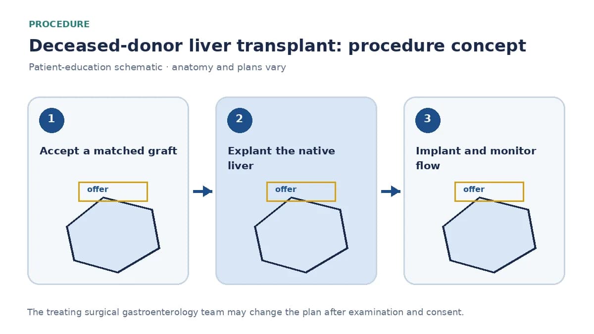 Clinical diagram of deceased-donor liver implantation after native hepatectomy