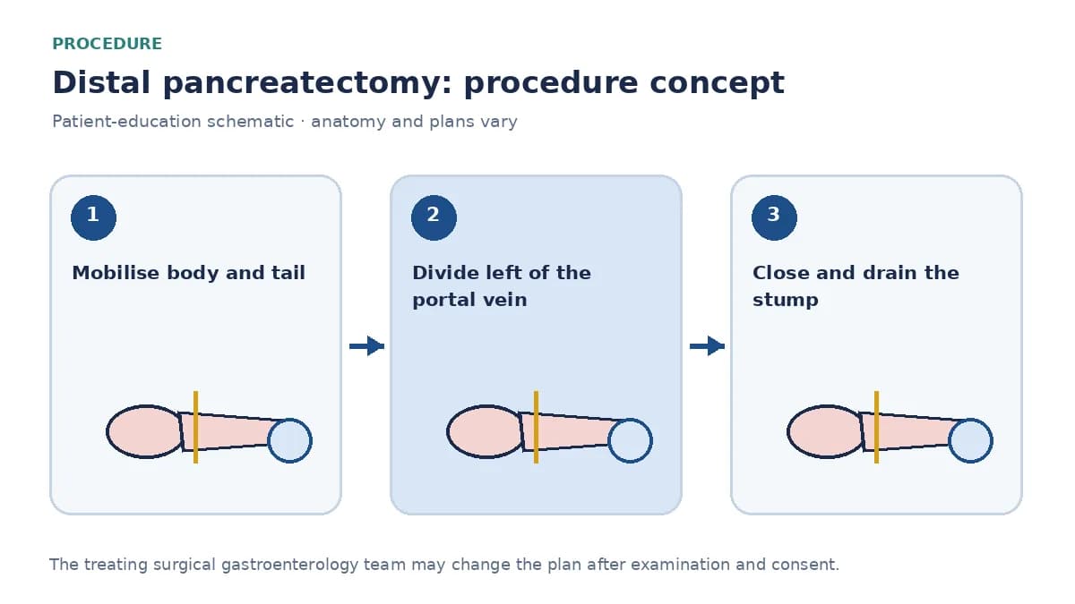 Clinical diagram of distal pancreatectomy showing division of the pancreas and optional splenectomy