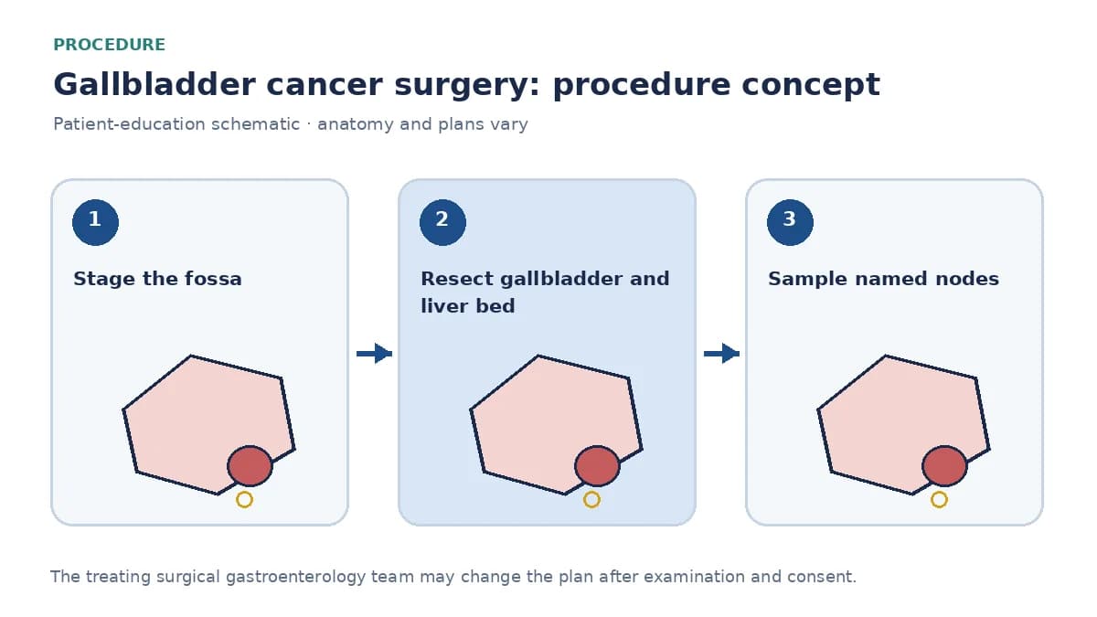 Clinical diagram of radical cholecystectomy with liver-bed resection and regional node sampling