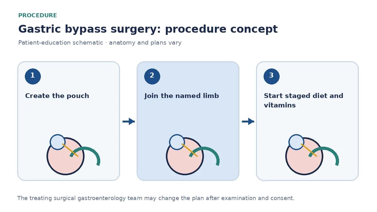 Clinical diagram of gastric-pouch creation and gastrojejunal anastomosis used in gastric bypass surgery