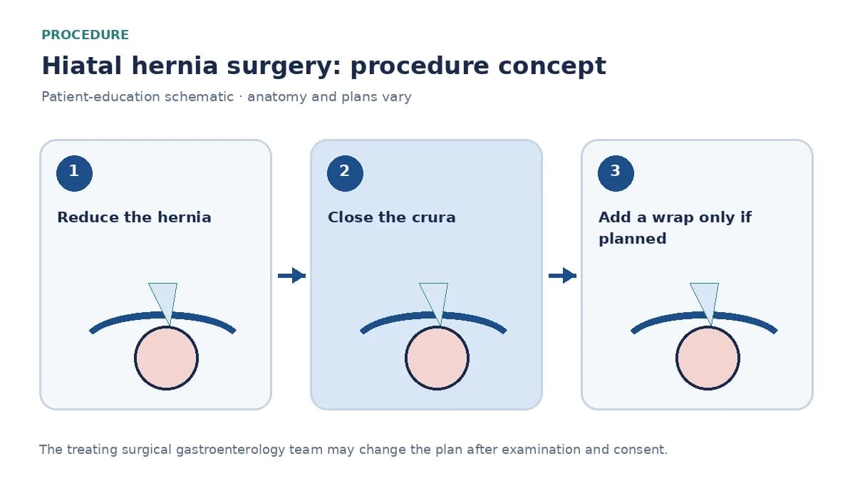 Clinical diagram of hiatal hernia reduction, crural repair and optional fundoplication