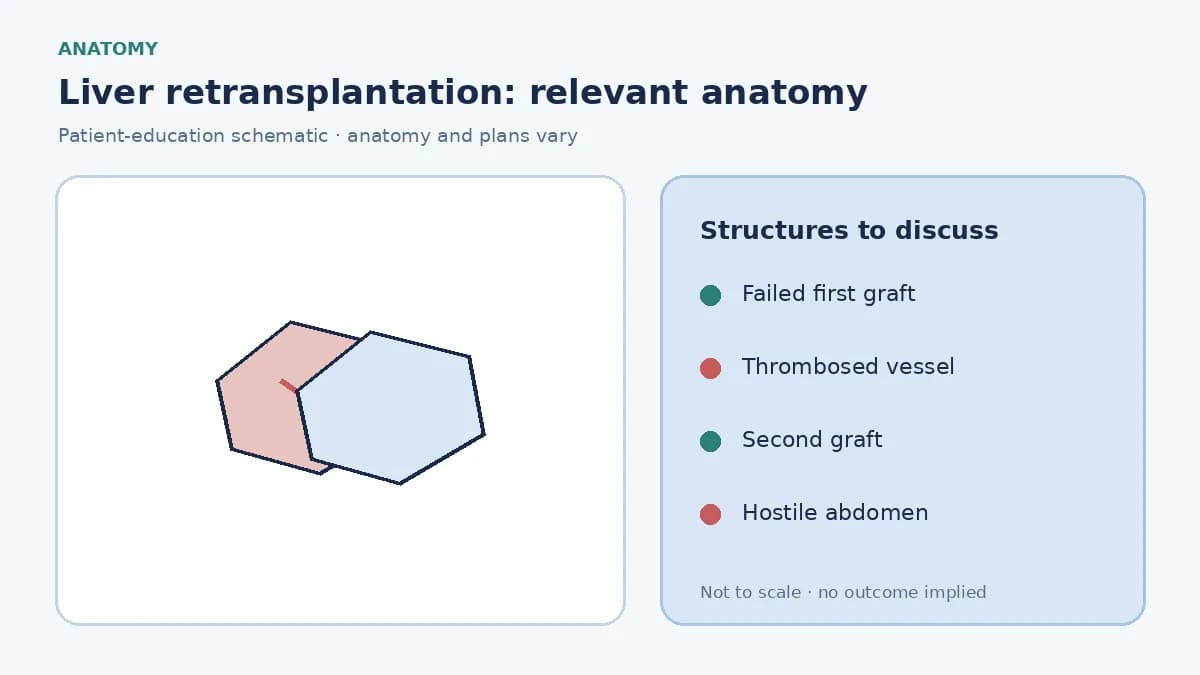Medical illustration of a failed liver graft with thrombosed vessels and the planned second-graft anatomy
