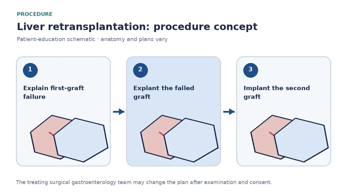 Clinical diagram of explanting a failed liver graft and implanting a second graft with vascular reconstruction
