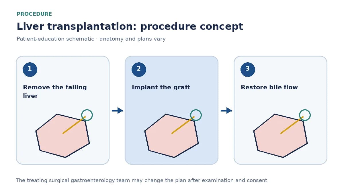 Clinical diagram of a donor liver graft being implanted with vascular and biliary anastomoses